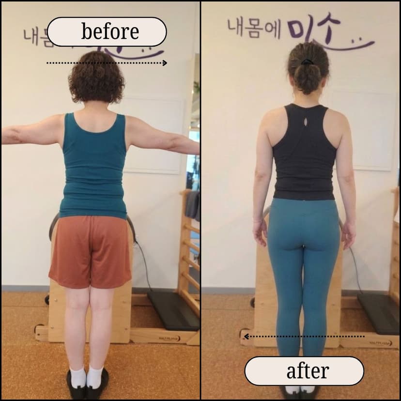 체형교정 비포에프터 1